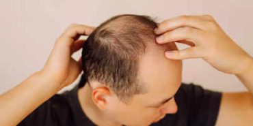 how-an-acne-medicine-may-help-reverse-hair-loss-and-baldness-in-males